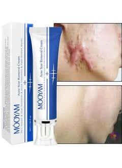 MOOYAM Scar Removal Cream Acne Scar Cream Rapid Repair Scar Cream for Acne Surgery Injury Burns Advanced Gel Acne Scar Spot Treatment Suitable for All Skin Types 30g  - Image 5