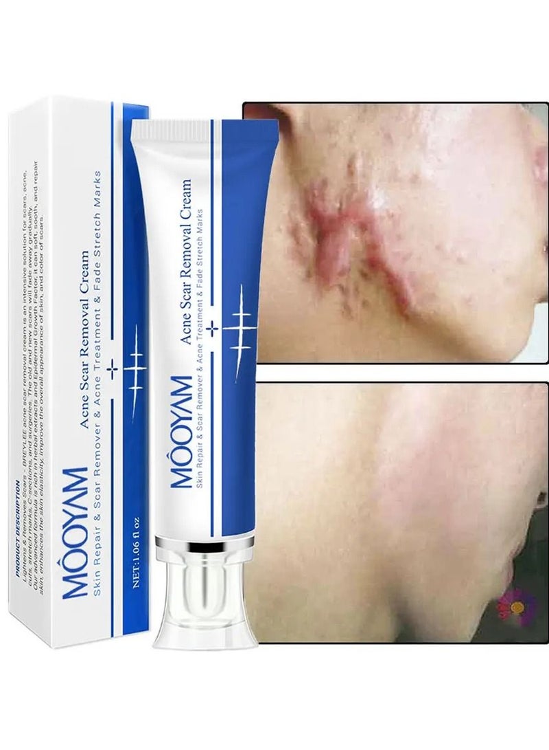 MOOYAM Scar Removal Cream Acne Scar Cream Rapid Repair Scar Cream for Acne Surgery Injury Burns Advanced Gel Acne Scar Spot Treatment Suitable for All Skin Types 30g  - Image 5
