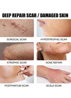 MOOYAM Scar Removal Cream Acne Scar Cream Rapid Repair Scar Cream for Acne Surgery Injury Burns Advanced Gel Acne Scar Spot Treatment Suitable for All Skin Types 30g  - Image 4