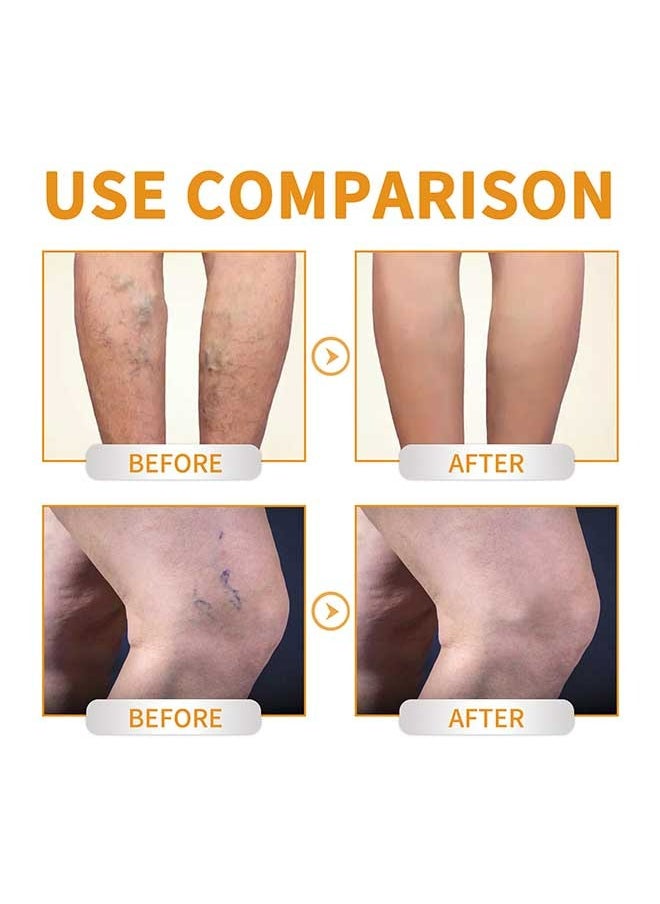EELHOE - Vitamin K Varicose Veins Cream, Soothing Leg Cream, Varicose and Spider Veins Treatment Cream, Improve Blood Circulation, Fast Relieve Swelling Pain 60g - Image 1