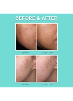 BLISS Clear Genius Acne Spot Treatment - 0.5 Fl Oz - Maximum Strength 2% Salicylic Acid Shrinks Blemishes - Clean - Vegan & Cruelty-Free  - Image 4
