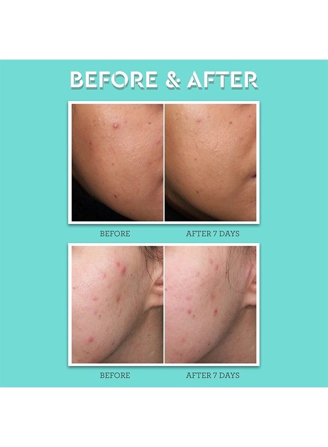BLISS Clear Genius Acne Spot Treatment - 0.5 Fl Oz - Maximum Strength 2% Salicylic Acid Shrinks Blemishes - Clean - Vegan & Cruelty-Free - Image 4