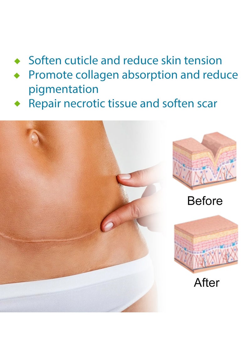 West&Month Silicone Scar Sheets, Scar Patch, Fade Scar Sticker, Efficient Beauty Scars Removal Cesarean Section Burn Scars Left Behind Gel Painless Tape Roll (4cm * 1.5m) - Image 3