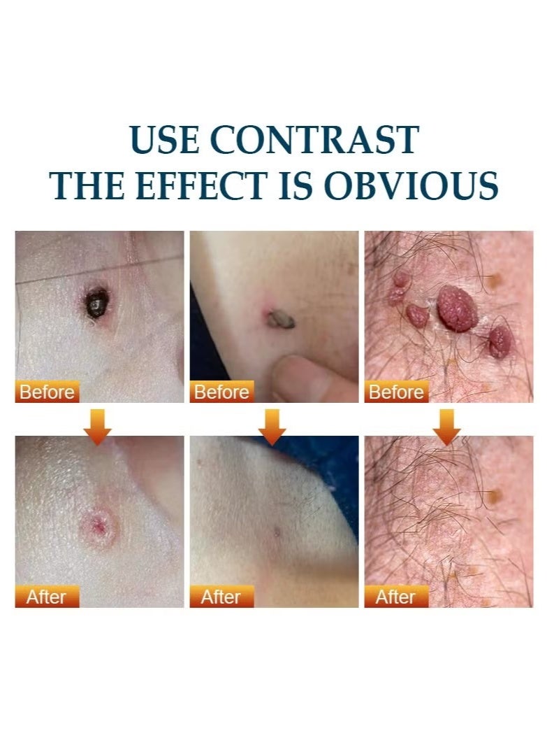 KanyeHB Wart Remover, Wart Remover Ointment, Wart Remover Freezer, Fast Acting Wart Remover Gel (Maximum Strength), Wart Remover Freezer, Wart Remover Cleansing Cream, Wart Remover Cream (20g) - Image 5