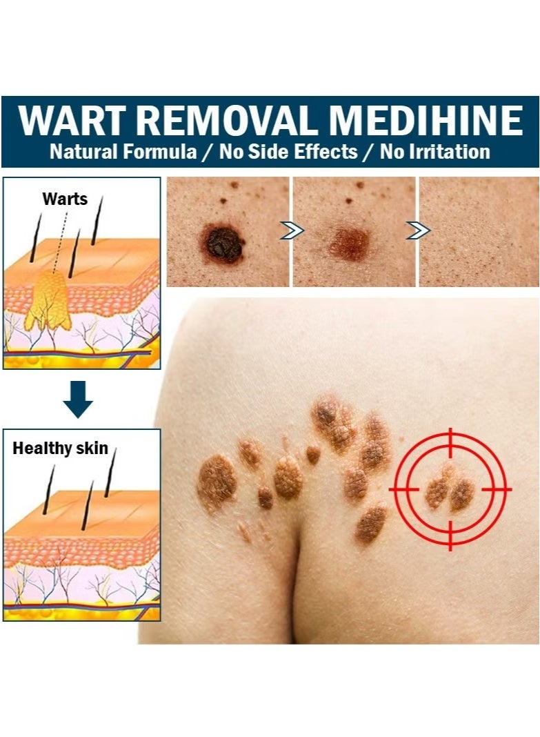 KanyeHB Wart Remover, Wart Remover Ointment, Wart Remover Freezer, Fast Acting Wart Remover Gel (Maximum Strength), Wart Remover Freezer, Wart Remover Cleansing Cream, Wart Remover Cream (20g) - Image 4