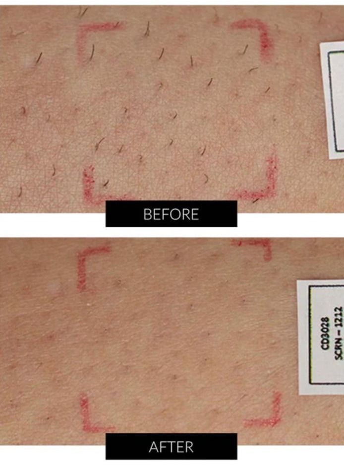 Smooth Skin Cosmetics - SmoothSkin Pure Fit IPL Hair Removal Device - Image 1