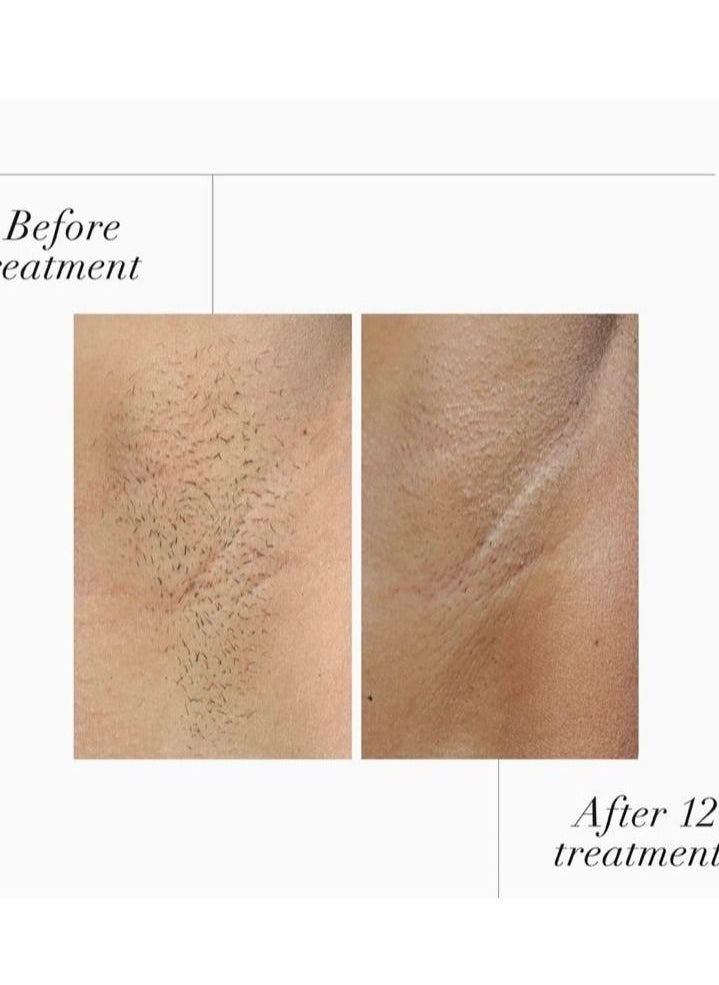 Smooth Skin Cosmetics - SmoothSkin Pure Fit IPL Hair Removal Device - Image 1