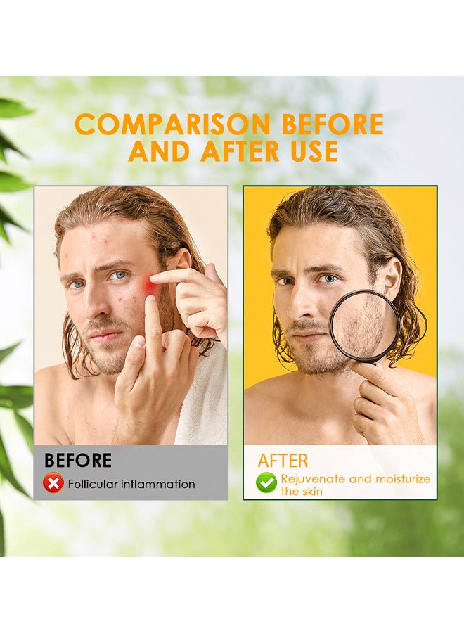 Sumifun Hair Follicle Cream, Scalp Hair Follicles And Hair Follicles With Acne, Treatment For Face And Body, Natural Cystic Acne Treatment, Premium Hair Follicle Cream And Pimple Remover, 20G - Image 4
