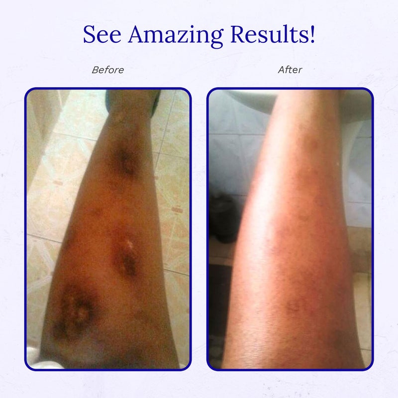 Rejuvaskin Scar Esthetique Scar Cream with Silicone, Reduces the Appearance of Surgical Scars, Burns, Stretch Marks, Keloids & Acne Scars, 30ml - Image 5