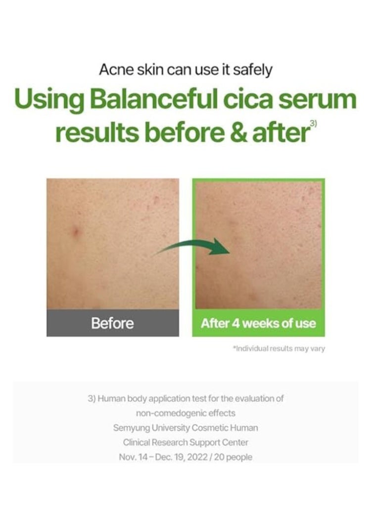 Torriden Soothing & Redness Relief – Torriden BALANCEFUL Cica Serum + Balanceful Cream Set for Calming Irritated, Sensitive Skin - Image 4