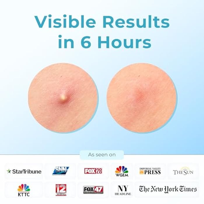 CLEOF Pimple Patches for Face & Body - Overnight Use, Visible Acne Patch for Zits, Spots, Pimples, Whiteheads, Vegan, Cruelty-Free, Hypoallergenic Hydrocolloid Stickers (56 Count, 10mm) - Image 2
