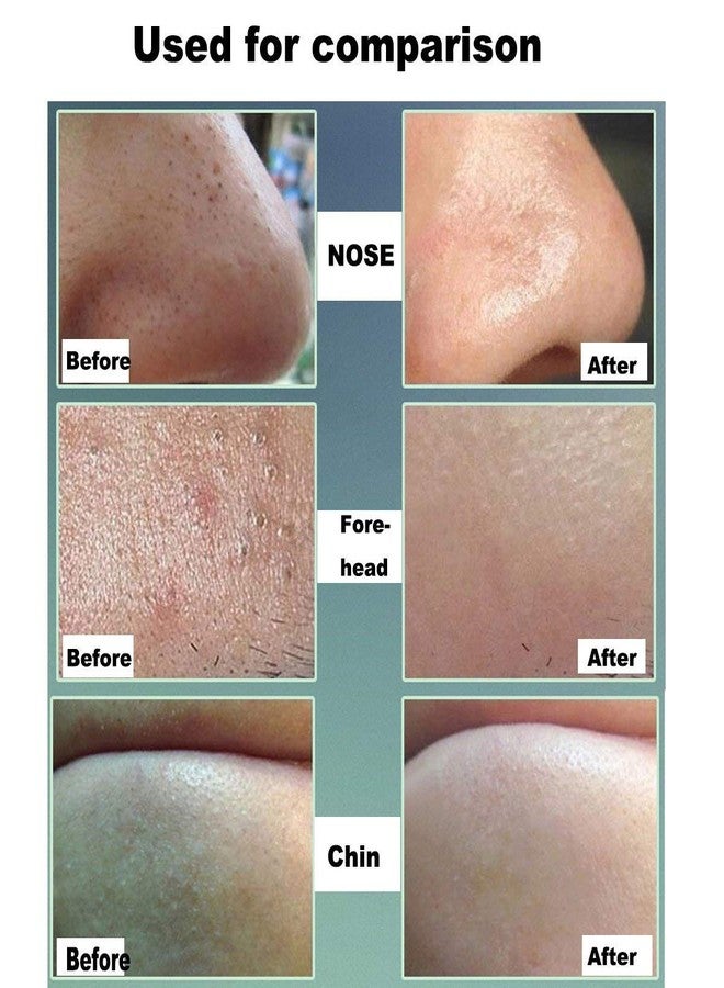 AVTY Blackhead remover,Pimple Popper,Whitehead Scar Extractor,ace Skin Care Kit - Pointed - Image 2