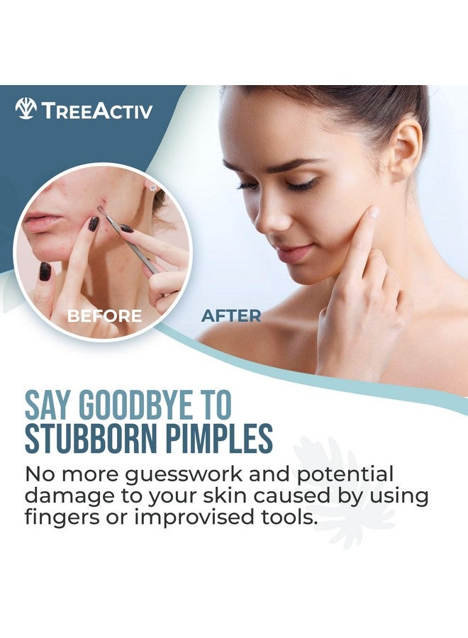 TreeActiv طقم أدوات إزالة الحبوب مع غسول الوجه و لاصقات حب الشباب أدوات إزالة الرؤوس السوداء الاحترافية طقم الوجه أداة استخراج الرؤوس السوداء من الفولاذ المقاوم للصدأ إزالة الحبوب والرؤوس السوداء والبيضاء - Image 2
