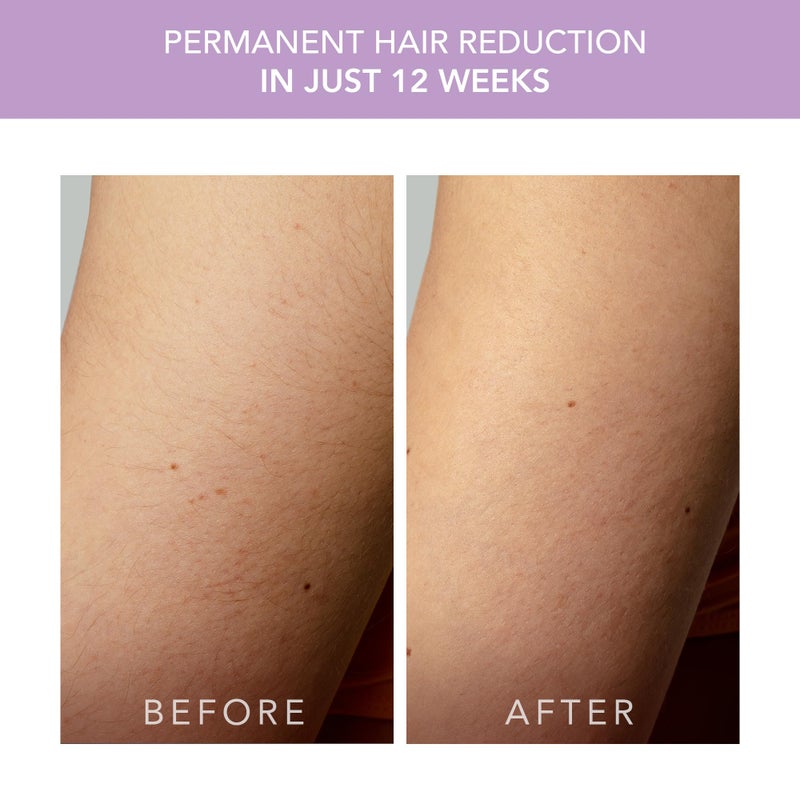 FOREO Peach 2 go IPL Hair Removal Device - Travel-Friendly Permanent Removal - Laser Treatment for Body & Face - Painless & Skin Cooling - Silicone Shield - Customizable - Lavander - Image 5