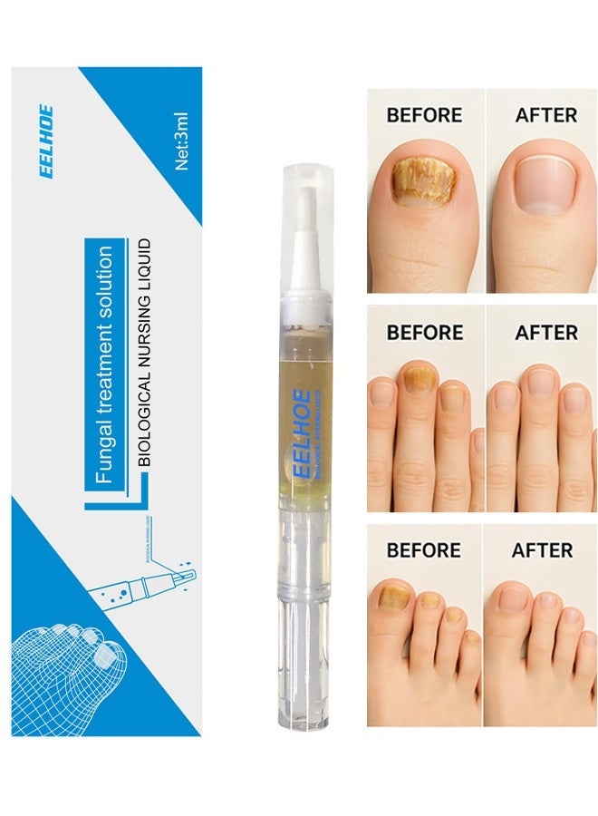 إيلهو حل علاج الفطريات، قلم إصلاح الفطريات للأظافر، سائل رعاية الفطريات للأظافر، للعناية اليومية باليدين والقدميين، لوشن للأظافر، تليين الأظافر السميكة، قلم إصلاح الأظافر الفطرية للأظافر التالفة، 3 مل. - Image 1