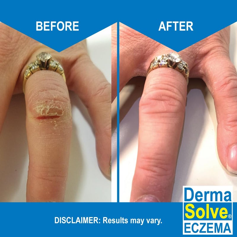 Dermasolve Eczema Relief Body Wash (2 Pack) | Protects, Moisturizes, and Repairs Skin - Kids, Babies & Adults - Steroid Free - Image 3