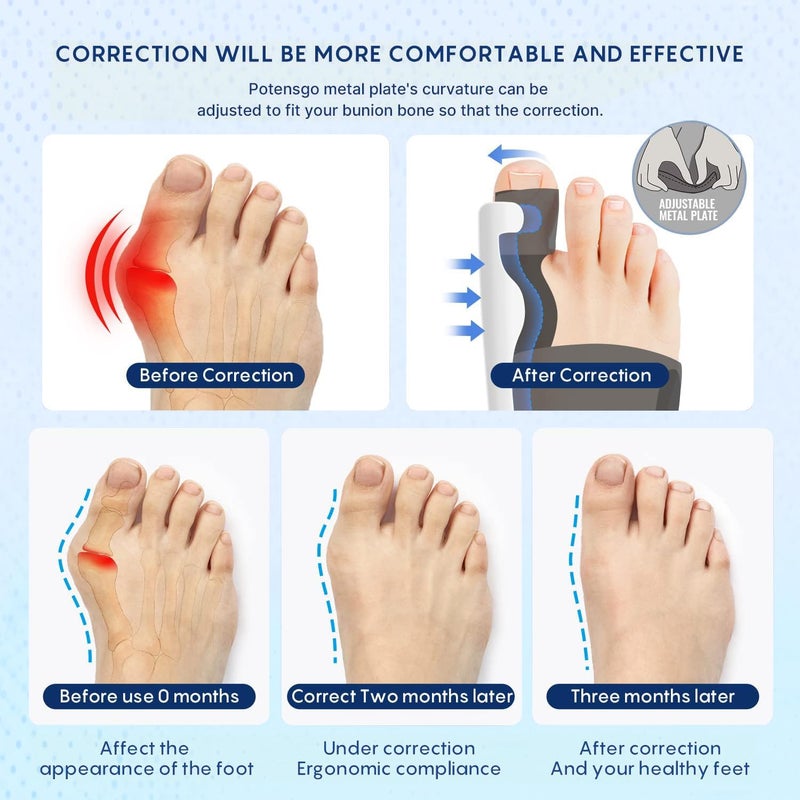 RANUR Bunion Corrector for Women & Men, Adjustable Toe Straightener with Rotating Knob, Bunion Splint & Toe Separator, Universal Fit for Left & Right Foot, Pain Relief & Hallux Valgus Alignment Support (GREY) - Image 4