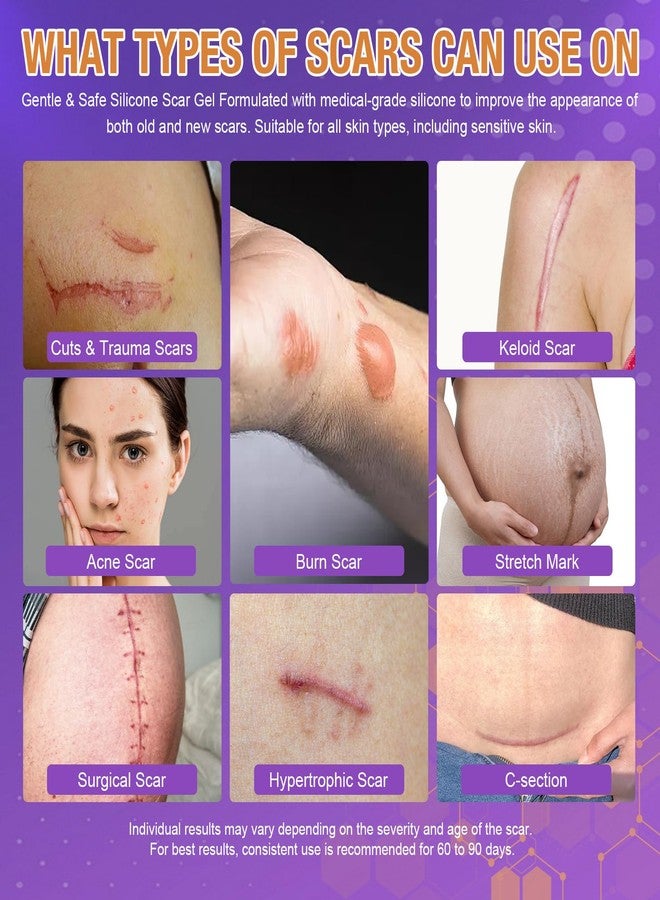 جل متطور لعلاج الندبات - جل سيليكون لإزالة النتوءات الجدرية، وندبات ما بعد الجراحة، وندبات حب الشباب، وآثار الحروق، وعلامات التمدد - علاج للندبات القديمة والجديدة - 35 غرامًا / 1.2 أونصة - Image 3