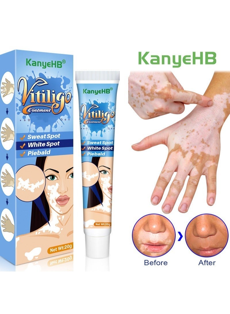 KanyeHB Vitiligo Ointment, Skin Vitiligo Treatment, Vitiligo Care Cream Reduces White Spots and Improves Skin Pigmentation (20g) - Image 2