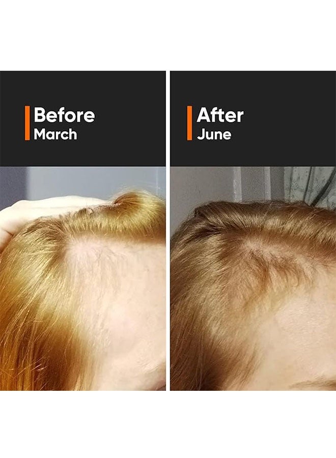 منيماليست مصل نشطات نمو الشعر 30 مل، يقلل من تساقط الشعر، يعزز النمو، مكافحة تساقط الشعر ونمو الشعر للرجال والنساء، مصل الشعر لجميع أنواع الشعر - Image 2