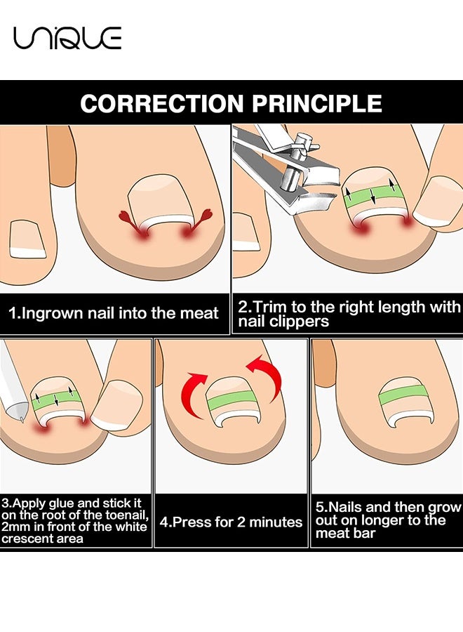 يونيك 60 قطعة مجموعة مصحح أظافر منغرسة - شرائط تصحيح أظافر منغرسة، مشبك لتقويم الأظافر، لصقة لإعادة تقويم أظافر منحنية للنساء والرجال للعناية بالقدم - شفاف - Image 4