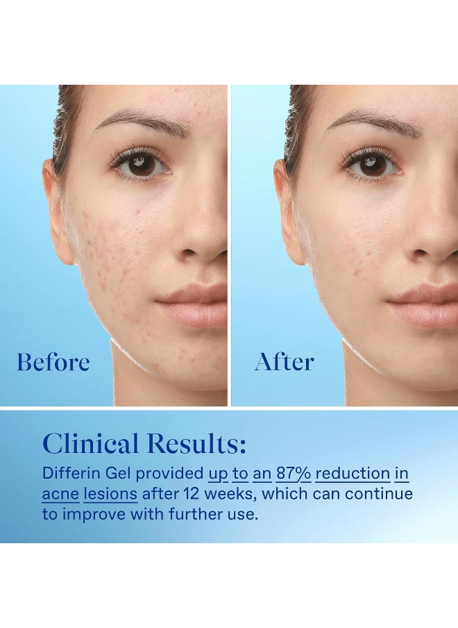 differin Differin Adapalene 0.1 Gel for Acne Treatment 15 gm  - Image 4