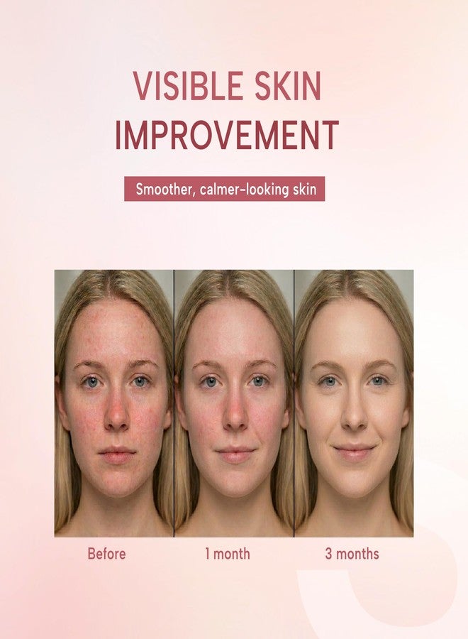 suquato 10% Azelaic Acid Cream – Rosacea Treatment for Face & Redness Reducing Face Cream – Redness & Blemish Care for Sensitive Skin – Lightweight Daily Use 30g - Image 2