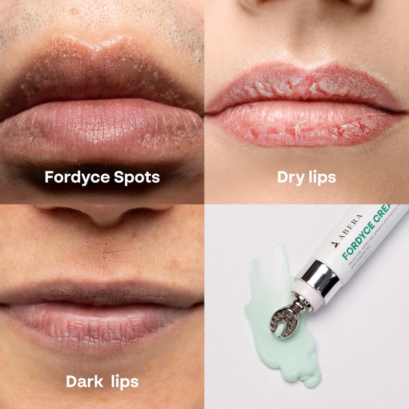 Abera Fordyce Cream â€“ Advanced Formula with HPR (Next-Gen Retinoids), Fordyce Spot Remover For Lips, All-day Moisturizing, Help Improve Dry, Chapped and Dark Lips, For Sensitive Lips (0.7 Oz) - Image 5