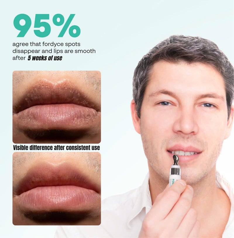 Abera Fordyce Cream â€“ Advanced Formula with HPR (Next-Gen Retinoids), Fordyce Spot Remover For Lips, All-day Moisturizing, Help Improve Dry, Chapped and Dark Lips, For Sensitive Lips (0.7 Oz) - Image 3