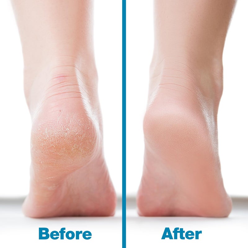 Probelle Double Sided Multidirectional Nickel Foot File Callus Remover - Immediately Reduces calluses and Corns to Powder for Instant Results, Safe Tool (Blue) - Image 5