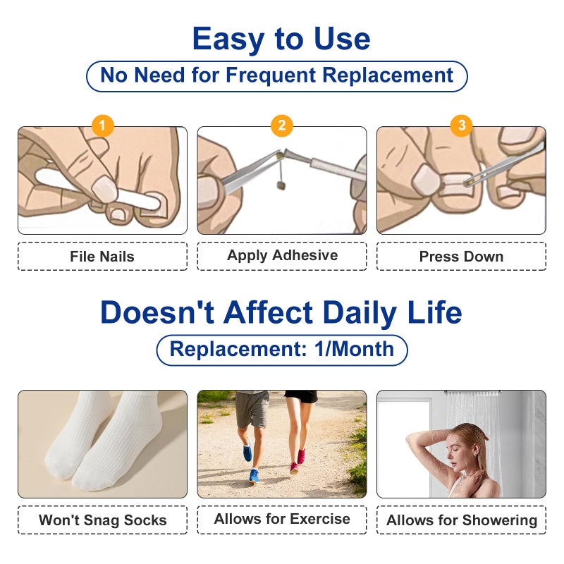 Yanxifei Nitinol Ingrown Toenail Corrector,at Home Ingrown Toenail Treatment,Curved Toenail Straightener,Ingrown Toe Nail Reliefï¼ŒIngrown Toenail Removal Kit (1/2 In,11/16 In) - Image 5