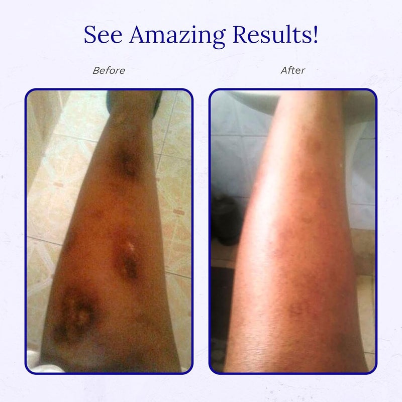 Rejuvaskin Scar Esthetique Scar Cream with Silicone - Image 5