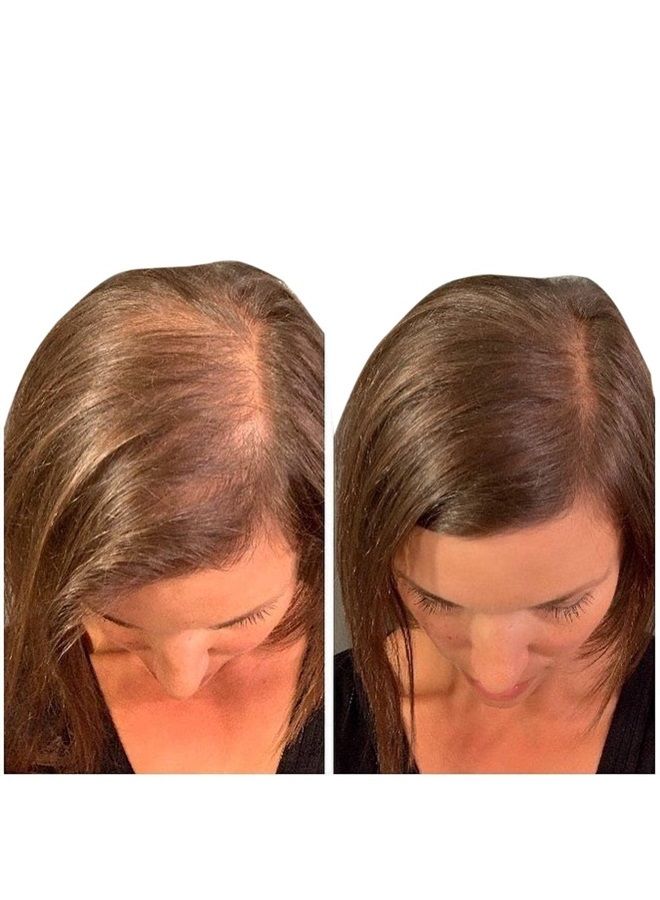 Thick Fiber THICK FIBER Hair Fibers for Thinning Hair & Bald Spots (MEDIUM BROWN) - 25g Bottle - Conceals Hair Loss in Seconds - Hair Powder For Women & Men - Image 2