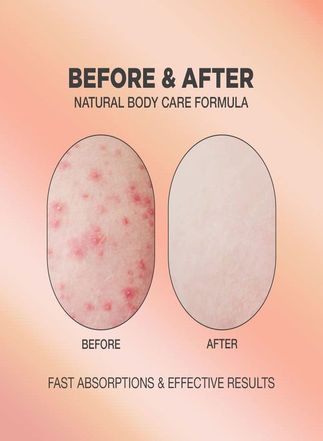 Proot Butt Acne & Ingrown Hair Treatment Serum | AHA & BHA Butt Acne and Ingrown Hair Treatment For Bikini Area | Get rid of Butt Acne, Ingrown Hair, Back Acne, Strawberry Legs, KP and Razor Bump | After Waxing Skin Care | Glycolic and Salicylic Acid Body Serum For Ingrown Hair, Butt and Back Acne Treatment Strawberry Legs | Ingrown Hair Cyst Treatment Formula for All Skin Type | Formulated with Centella Asiatica, Green Tea, Rosemary and Natural Ingredients | 1.69 oz - Image 2