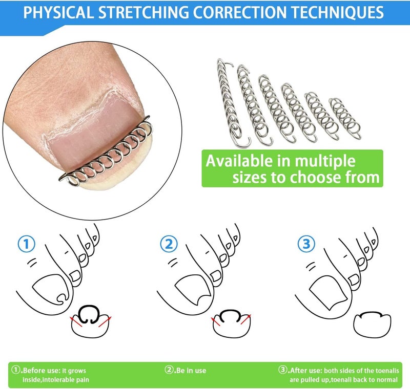 HANNEA Ingrown Toenail Treatment Kit Professional Ingrown Toenail Corrector Patch and Ingrown Toenail Corrector Strips Podiatry Toenail Braces for Corrects And Relieves Toenail Pain - Image 5