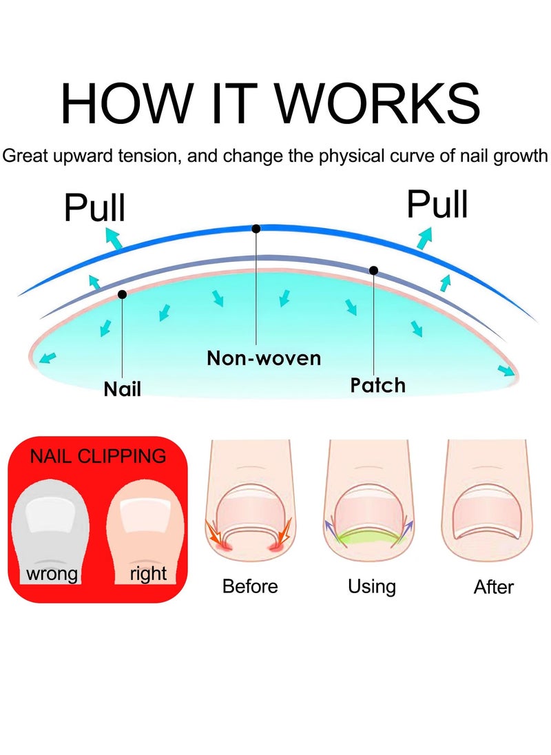 SYOSI - 200PCS Ingrown Toenail Strips Breathable Ingrown Toenail Corrector Strips Toenail Corrector Patch fro Ingrown Toenail Treatment Ergonomic Design for Comfortable Fit Painless Ingrown Toenail Tool - Image 1
