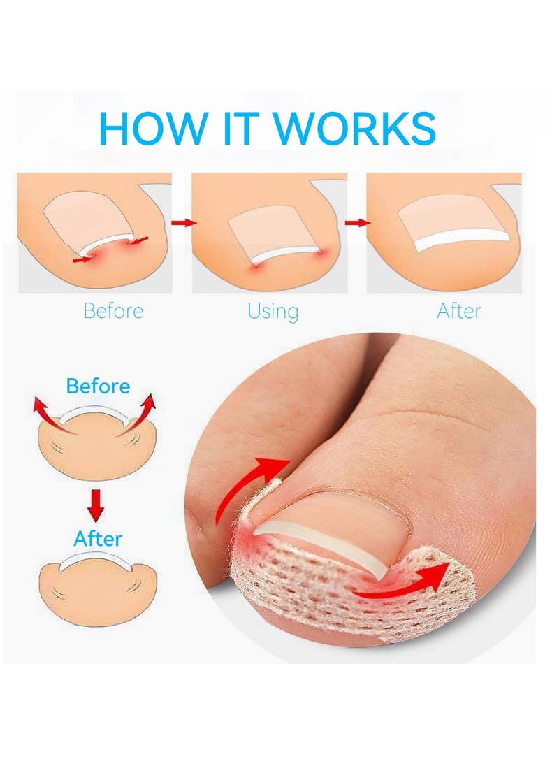 SYOSI - 200PCS Ingrown Toenail Strips Breathable Ingrown Toenail Corrector Strips Toenail Corrector Patch fro Ingrown Toenail Treatment Ergonomic Design for Comfortable Fit Painless Ingrown Toenail Tool - Image 1