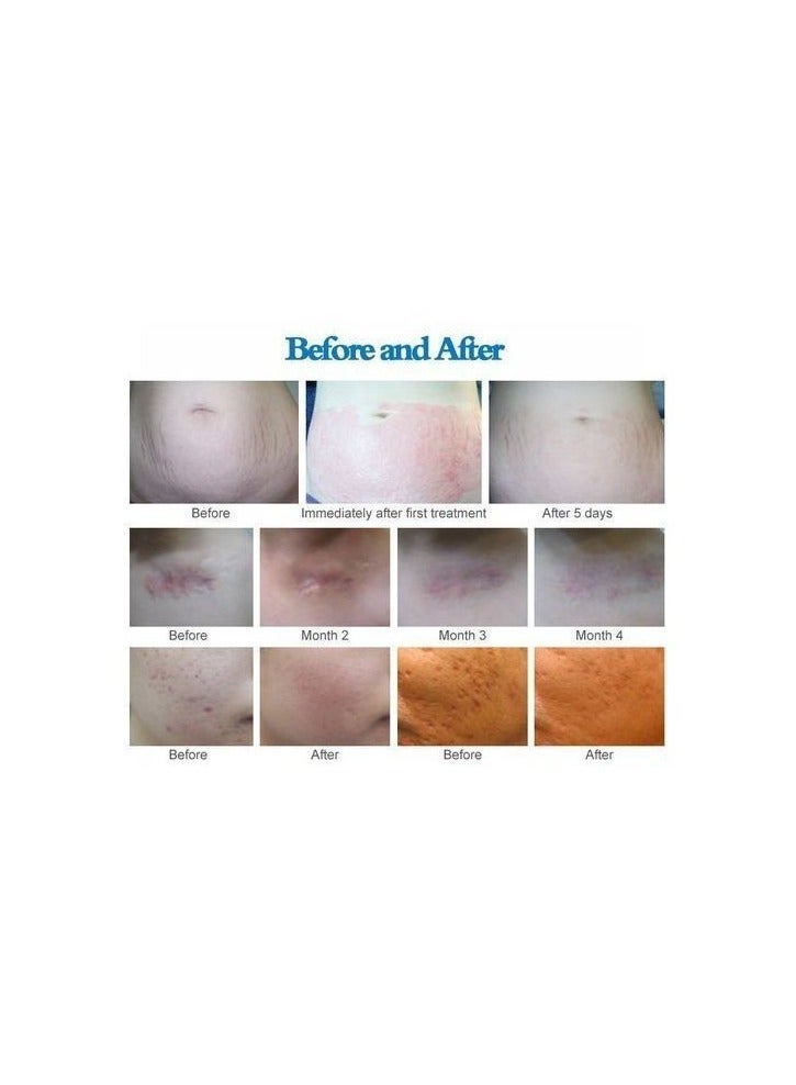 دكتور بن قلم وخز بالابر الدقيقة احترافي التيما A1 لاسلكي وكهربائي من ادوات اصلاح البشرة - Image 2