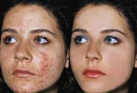 Diana كريم تفتيح البشرة ديانا BB مع حماية UVA/UVB 50 جرام من إيلس ستار لمشاكل التصبغ للبشرة السوداء والآسيوية والصومالية والعربية - Image 5