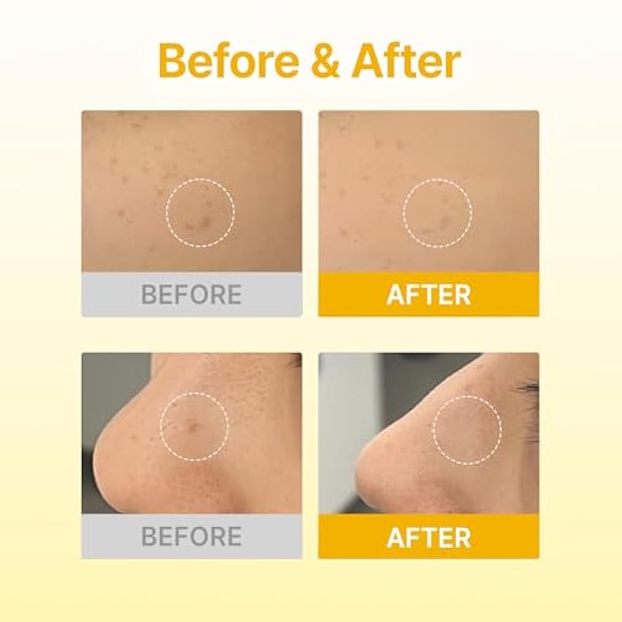 Acropass Microcone Pimple Patch Dark Spot Care - Post-Blemish, Redness, Vitamin C, Niacinamide, Dermatologist Tested, Non-Irritating, Cruelty Free (12 Patches + 12 Cleansers) - Image 3