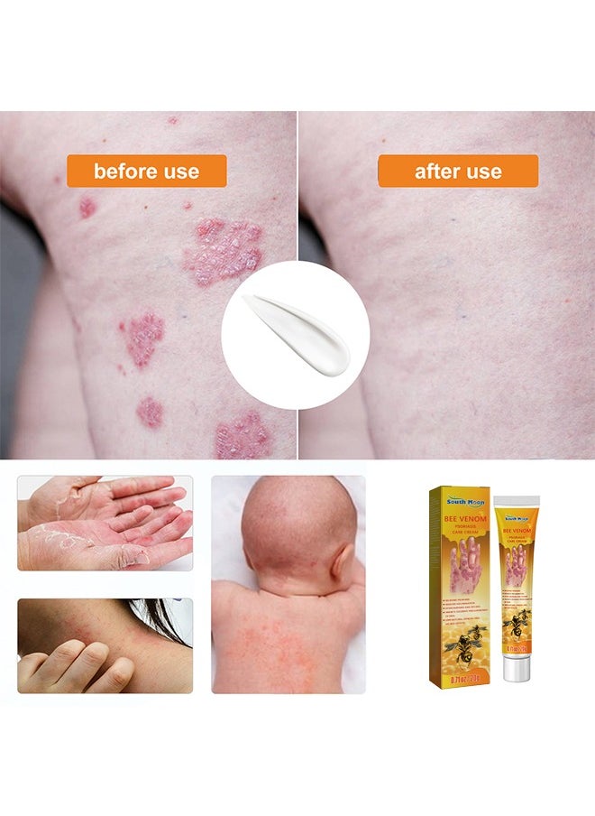 SOUTH MOON Bee Venom Psoriasis Cream, New Zealand Bee Venom Professional Psoriasis Cream For Itchy Skin Fast Relief Cream For Face And Body, Soothing And Moisturizing Psoriasis Cream 20G  - Image 5