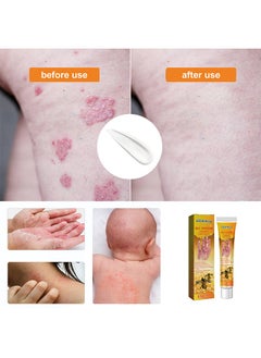 SOUTH MOON Bee Venom Psoriasis Cream, New Zealand Bee Venom Professional Psoriasis Cream For Itchy Skin Fast Relief Cream For Face And Body, Soothing And Moisturizing Psoriasis Cream 20G  - Image 5