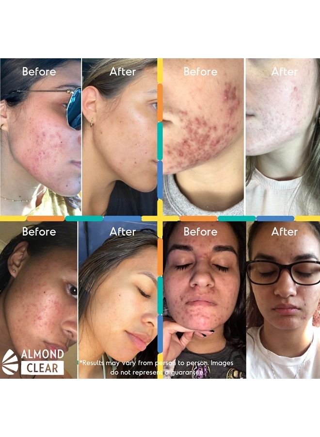 Almond Clear سيروم تنظيف الوجه والجسم، المستوى 1 - لعلاج حب الشباب، التهاب الجريبات الشعرية، شيخوخة البشرة، الشعر الناشئ، البقع الداكنة - الوجه، الصدر، المؤخرة، الظهر، الفخذين، الذراعين - حمض الماندليك - 1 أونصة سائلة - Image 3