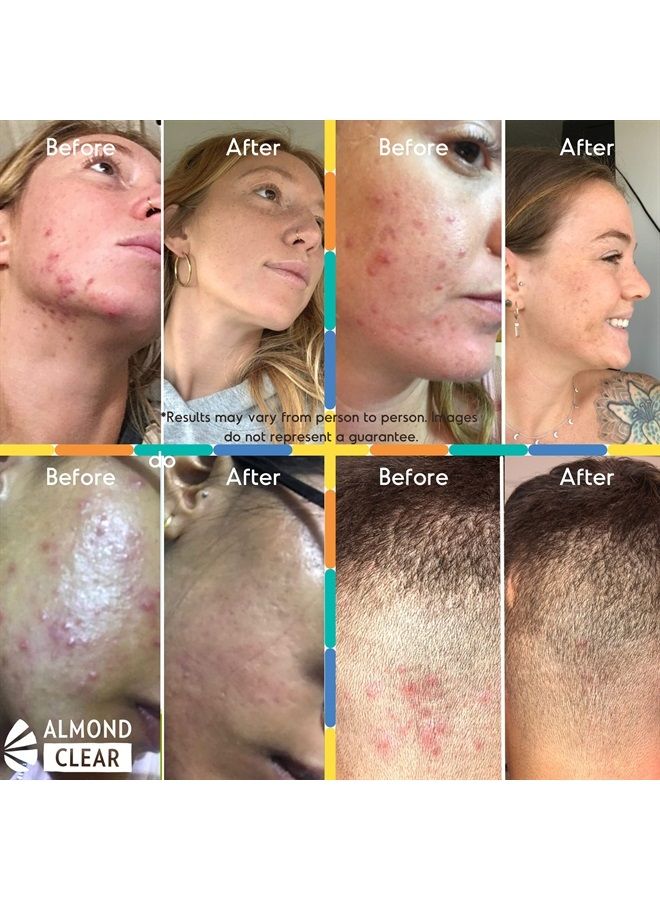 Almond Clear سيروم تنظيف الوجه والجسم، المستوى 1 - لعلاج حب الشباب، التهاب الجريبات الشعرية، شيخوخة البشرة، الشعر الناشئ، البقع الداكنة - الوجه، الصدر، المؤخرة، الظهر، الفخذين، الذراعين - حمض الماندليك - 1 أونصة سائلة - Image 4