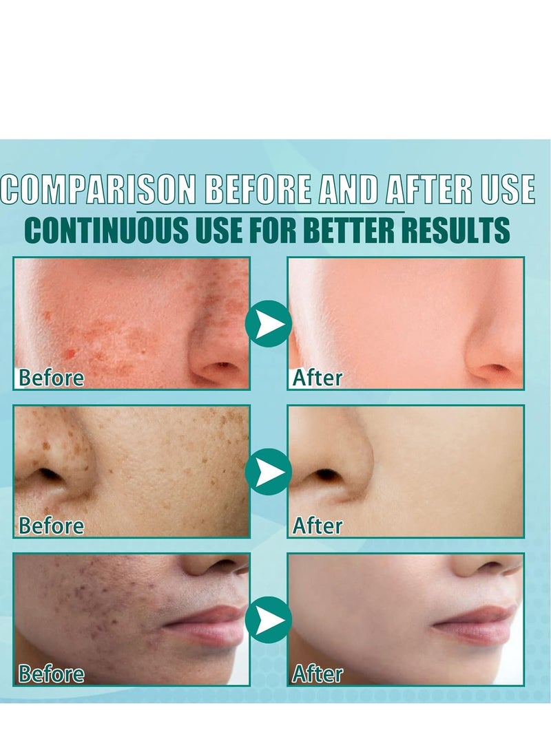 SOUTH MOON - Herbal Whitening Freckle-Removing Cream – Natural Dark Spot Corrector, Effective Whitening & Anti-Freckle Treatment for Men and Women, Reduces Dark Spots & Freckles 20g - Image 1