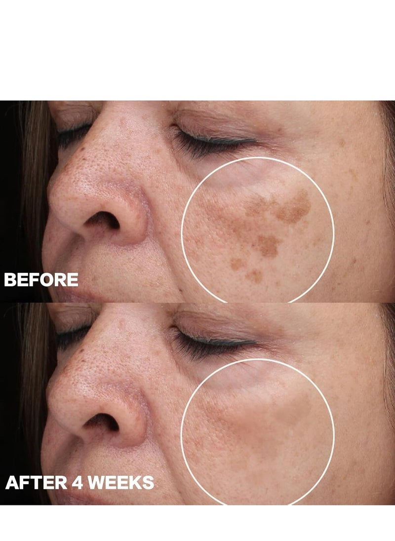 SOUTH MOON - Herbal Whitening Freckle-Removing Cream – Natural Dark Spot Corrector, Effective Whitening & Anti-Freckle Treatment for Men and Women, Reduces Dark Spots & Freckles 20g - Image 1
