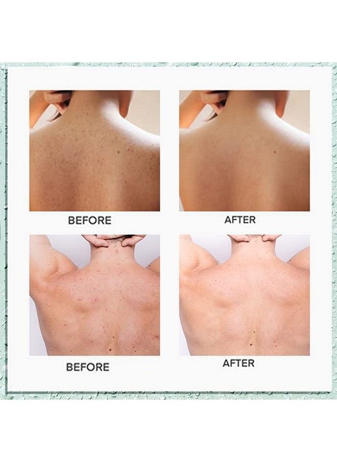 CIZ - Back Acne Treatment Back Acne Spray 2% Salicylic Acid Spray With Herbal Formula Body Acne Treatment For Teens Bacne Treatment Perfect Companion For Acne Body Wash And Salicylic Acid Body Wash - Image 1