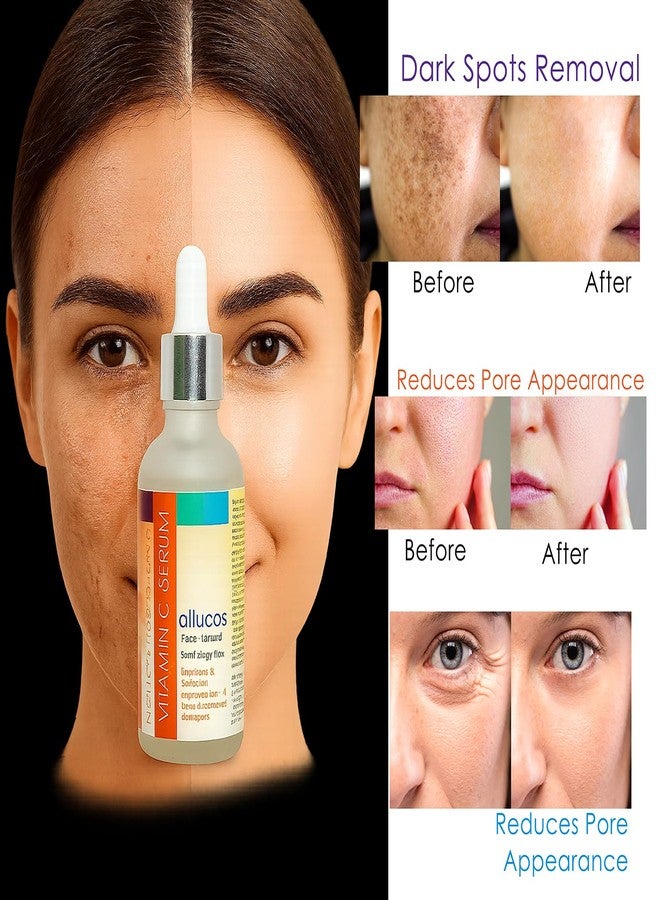 ALLUCOS Anti-Acne & Vitamin C Serum Combo - The Ultimate Skincare Duo for Acne-Prone Skin | Pack of 2 (30ML Each) - Image 5