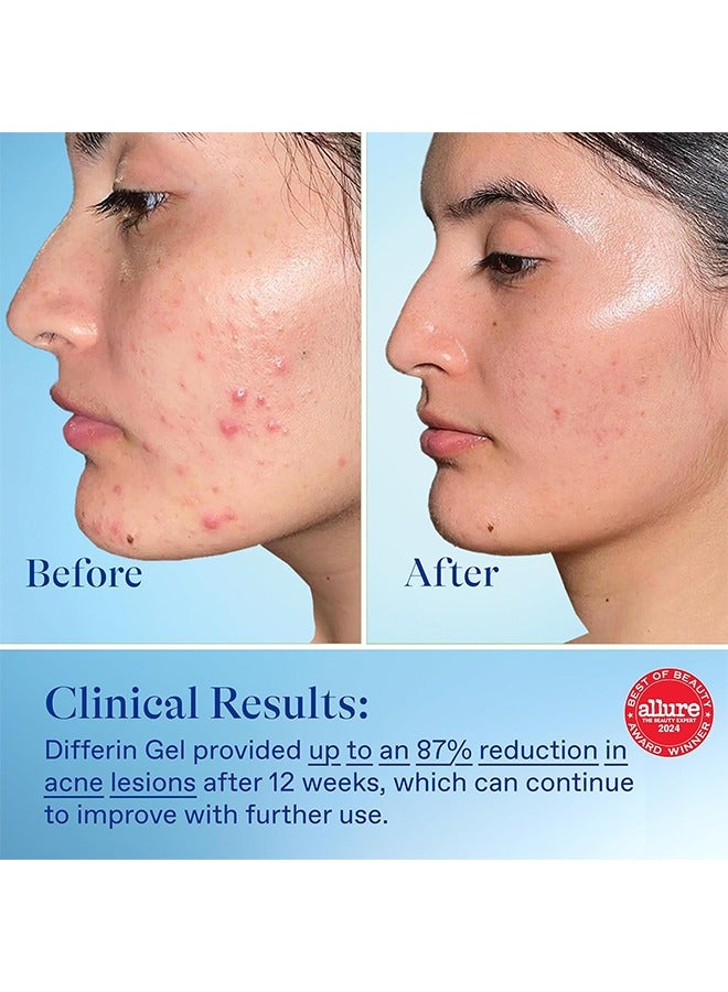 Differin Acne Treatment Gel, 90 Day Supply, Retinoid Treatment for Face with 0.1% Adapalene, Gentle Skin Care for Acne Prone Sensitive Skin, 45g Pump - Image 4