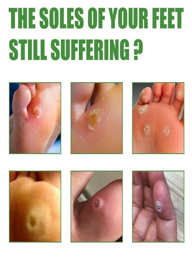 EELHOE   Wart Removal Treatment Relief Corn Pain and Foot Care Maximum Strength One Step Plantar Wart Remover Foot Pads, 30Count - Image 2